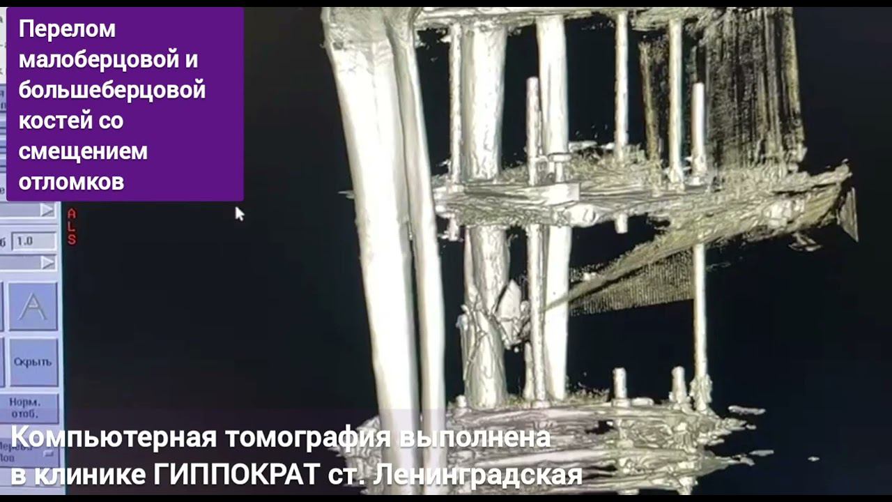 КТ голеностопного сустава. Перелом малоберцовой и большеберцовой костей со смещением отломков
