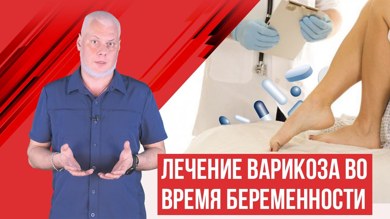 Профилактика Варикоза Беременных