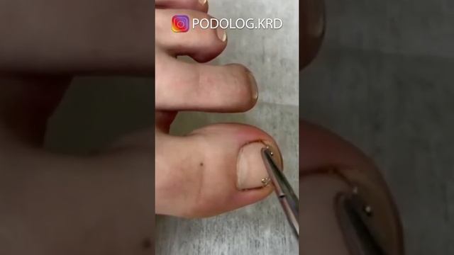 Самый лёгкий и результативный способ,  избавиться от выросшего ногтя!!!