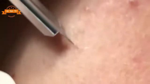 Удаление прыщей с носа и щек Spa G#080
