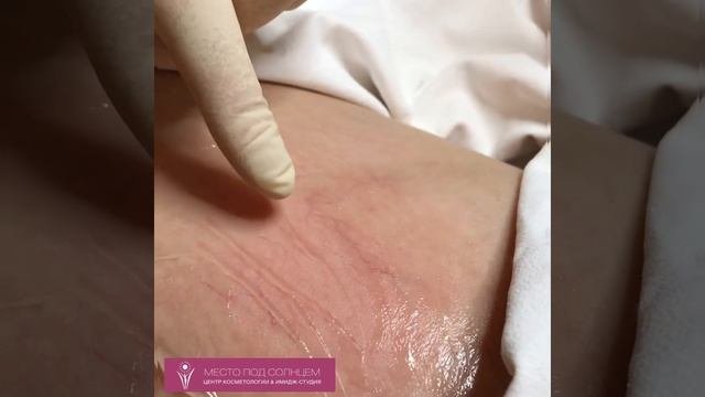 Отзывы о процедуре удаления сосудов