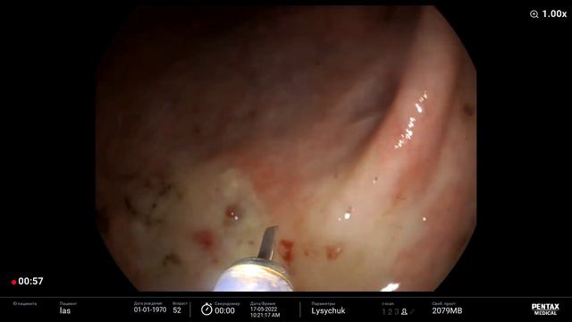 Dieulafoy ulcer Дьелафуа-подобный дефект Forrest IIA инъекционный гемостаз