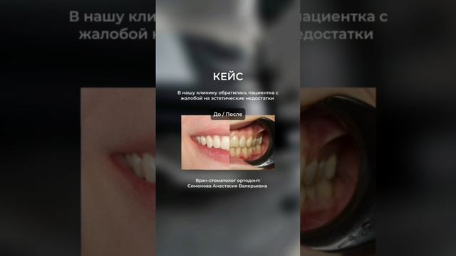 Кейс по ортодонтии, ортодонт Симонова