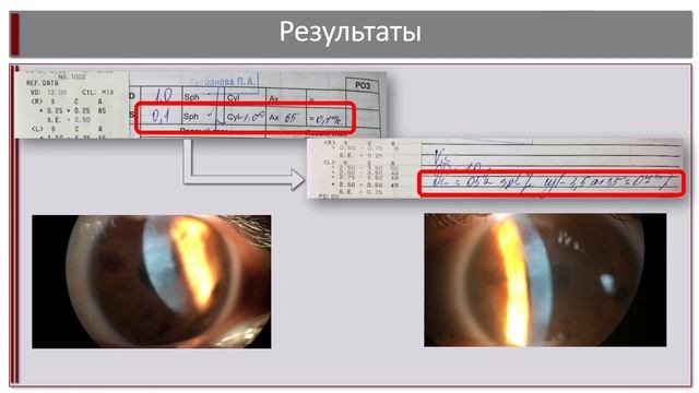 Клинический случай лазерного кераторефракционного лечения... – Майчук Наталья Владимировна