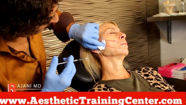 Watch NEW MOLDED THREAD LIFT- PDO Infinity from NovaThreads Before and After