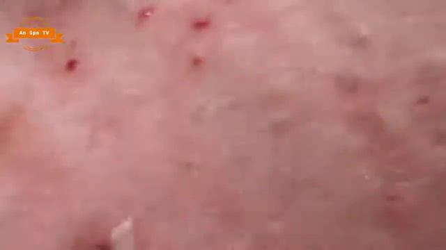 Удаление прыщей с носа и щек Spa G #067