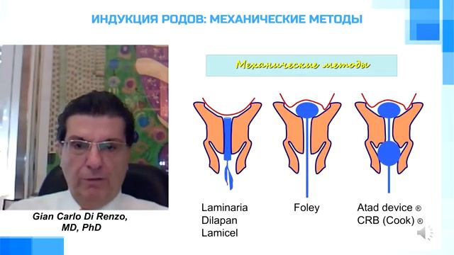 Индукция родов Механические методы проф Джан Карло Ди Ренцо Италия Кемерово апрель 2020