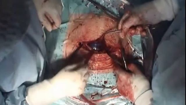 Видео: Использование Гемоблок при Кесаревом сечении (гемостаз Гемоблоком смотреть с 10-й минуты)