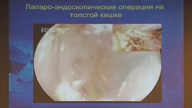 3   04   С В  Джантуханова   Роль Внутрипросветной Эндоскопии при выполнении Эндохирургических Опер