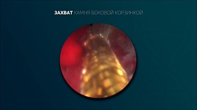Лазерная литотрипсия. Видео 5.