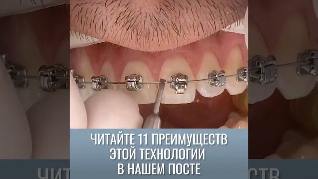 Самолигирующиеся брекеты по VIP протоколу. Исправление прикуса и выравнивание зубов. Ортодонт.