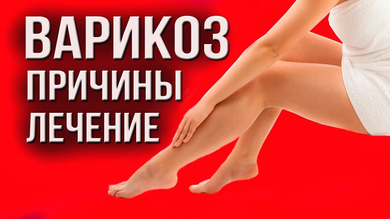 Варикоз: причины, симптомы, методы лечения. Как лечить варикоз? Советы доктора