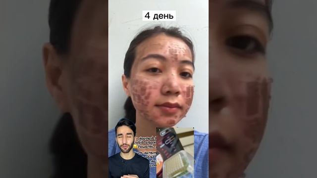 микро игольчатый РФ