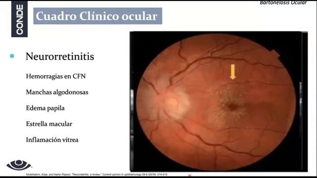 UVEITIS Intermedias Infecciosas