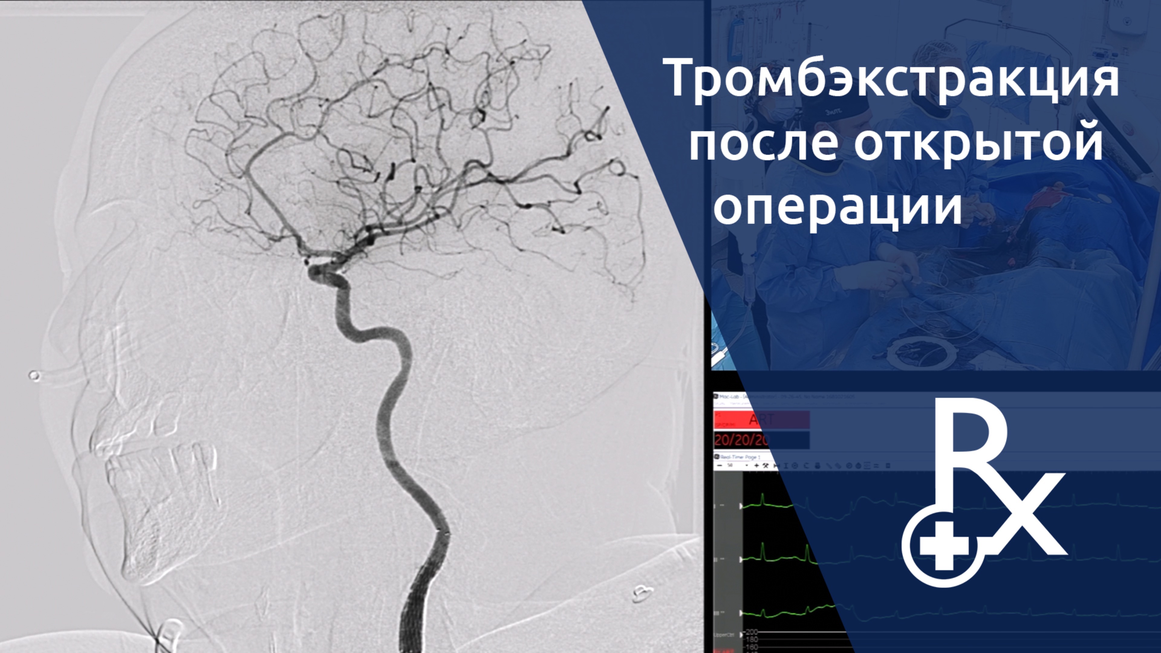 Тромбэкстракция из общей сонной артерии