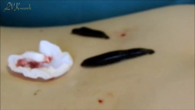Очищение организма пиявками