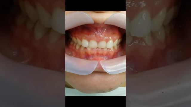 Результат в конце #стоматологалматы #брекетыалматы #винирыалматы #ортодонталматы