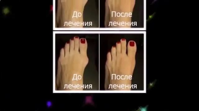 косточка около большого пальца ноги