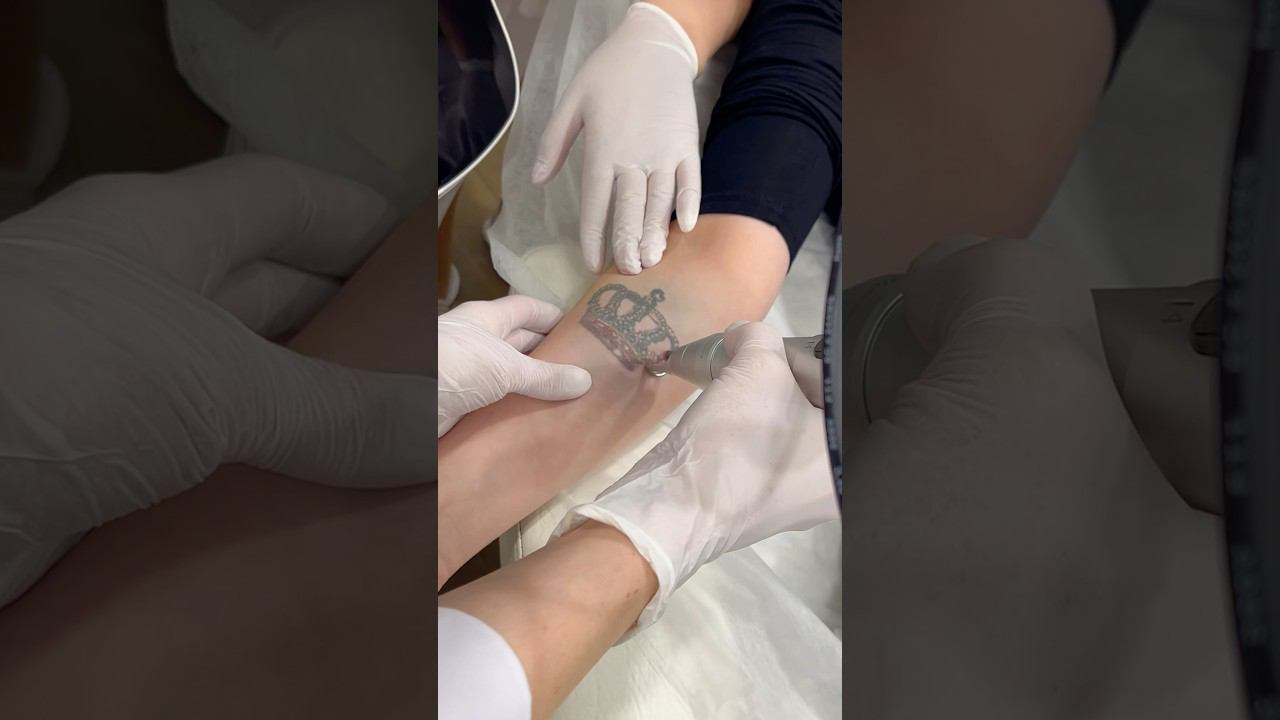 Удаление тату на аппарате Picocare