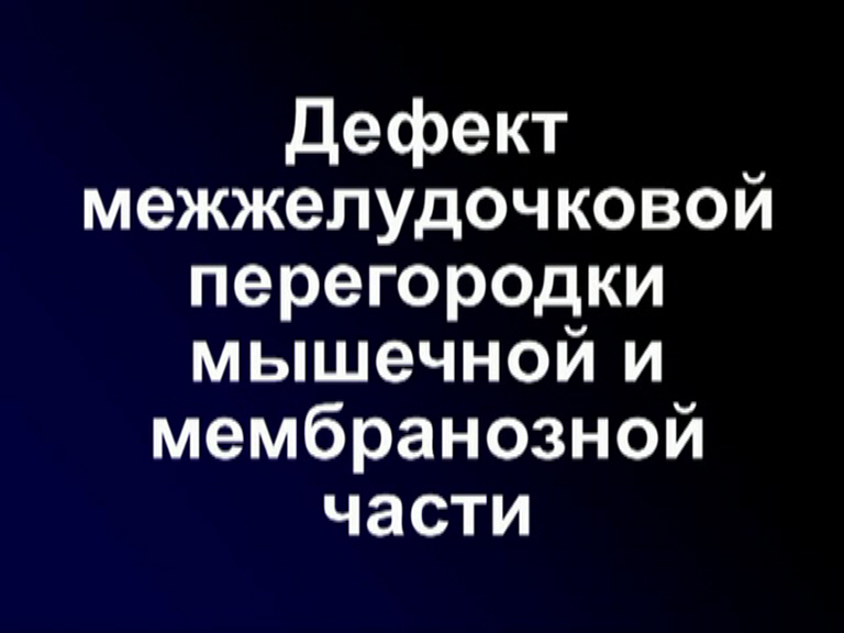ДМЖП мышечной и мембранозной части. Запись видео 1995 года.
