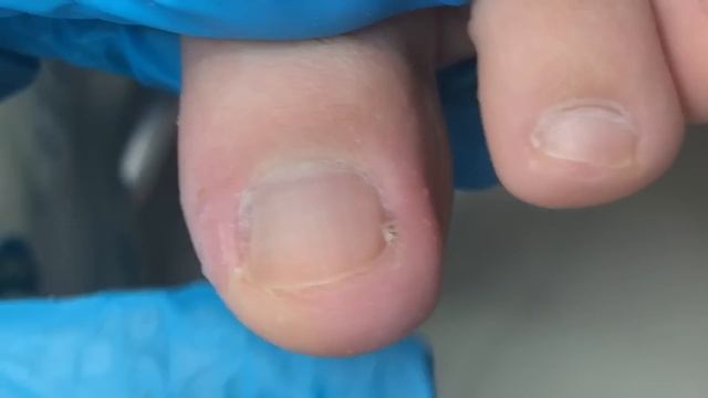 Ingrown nails make toes swell and peel!【Crazy pedicure room】