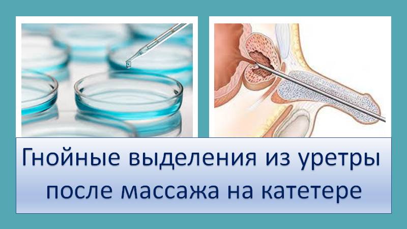 Гнойные выделения из уретры после массажа на катетере