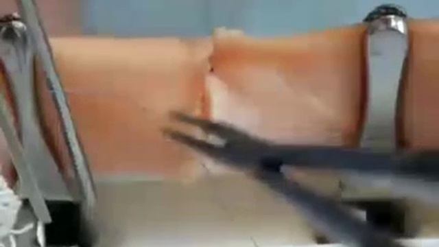 Циркулярный обвивной шов по Каррелю
