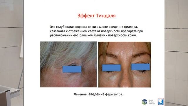 Осложнения после контурной пластики. Эффект Тиндаля