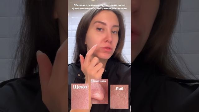 Кожа в увеличении после фотоомоложения IPL