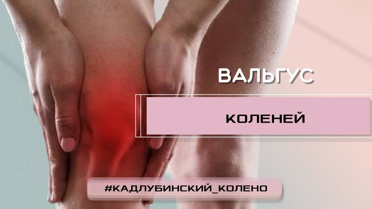 Вальгус колена