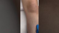 Эпиляция александритовым лазером candela - результат #депиляция #удалениеволос #лазернаяэпиляция