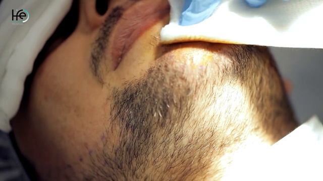 BEARD RECONSTRACTION. Method HFE