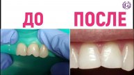 Лечение и эстетическая реставрация зубов