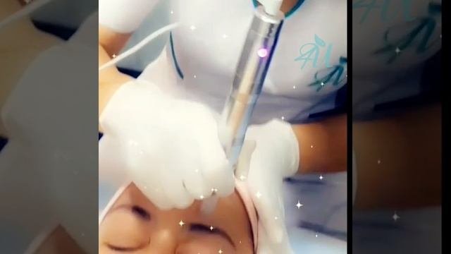 Beauty Center For You , MICRONEEDLING - Avant et après - Anti-âge - Anti-tâches