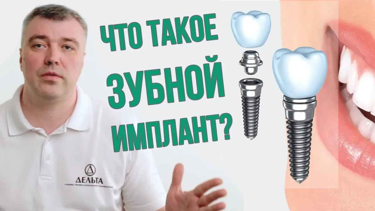 Нужно ли устанавливать зубной имплант