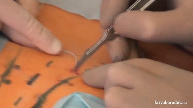 Имплантация сакрального квадриполярного электрода