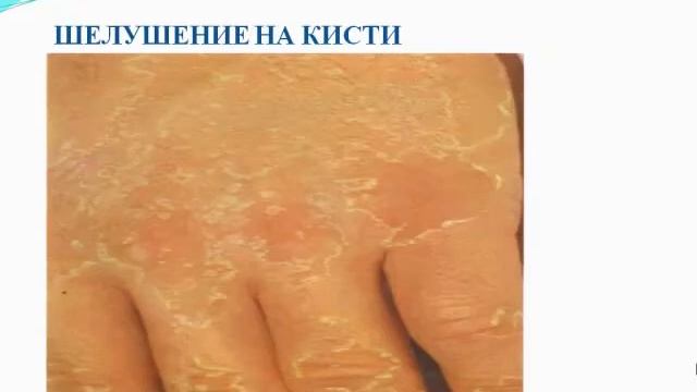 Инфекционные заболевания протекающие с экзантемой