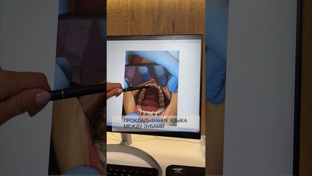 Инфантильный тип глотания или прокладывание языка между зубами. Детская ортодонтия в Сочи