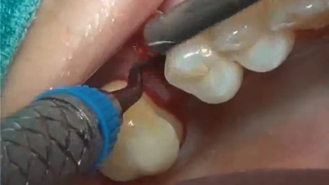Preventive collagen graft in sinus lift