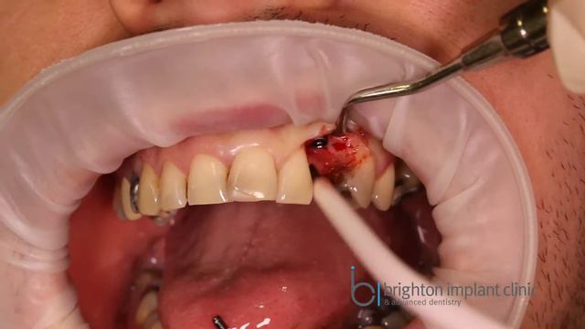 How To Remove A Broken Dental Implant Abutment Screw