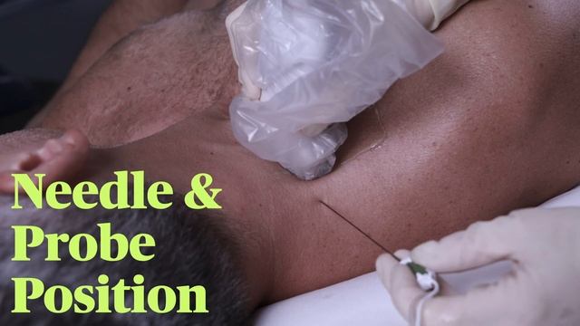 Ultrasound guided stellate ganglion block