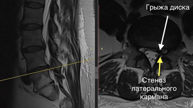Лечение грыжи диска отзыв после эндоскопической операции