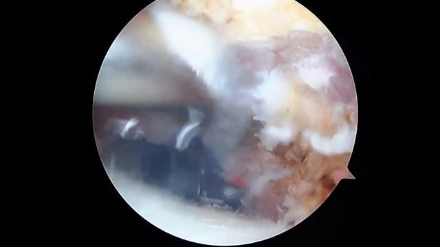 R Shoulder Rotator Cuff Repair And Biceps Tenodesis 9.14.20