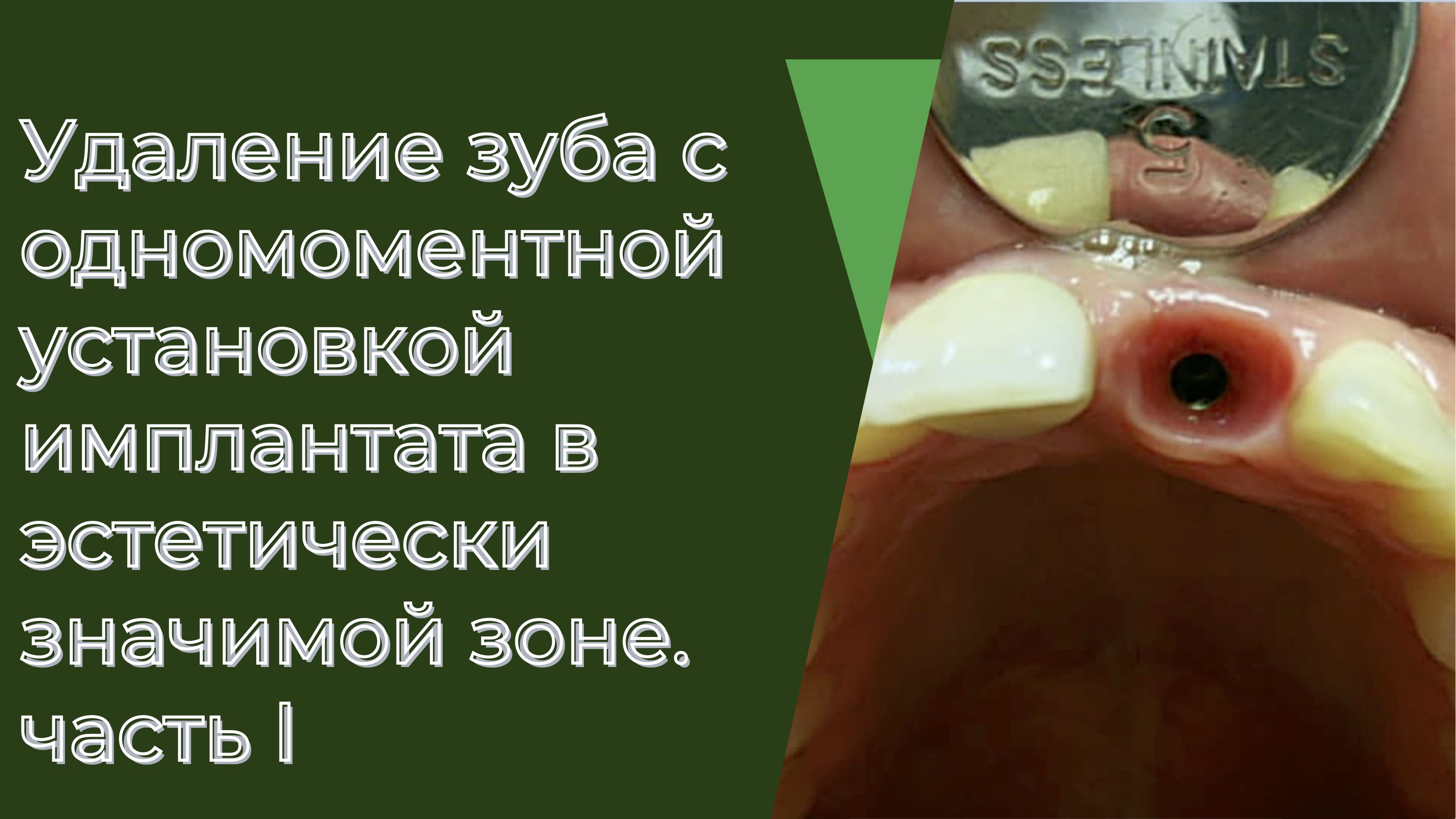 Удаление зуба и кисты с одномоментной установкой имплантата в эстетически значимой зоне.