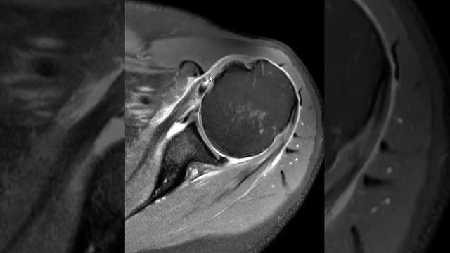 Biceps Tendon Dislocation And The Pectoralis Tendon Insertion.