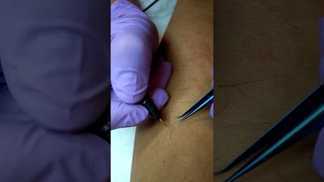 ЭЛЕКТРОЭПИЛЯЦИЯ НА ГОЛЕНИ