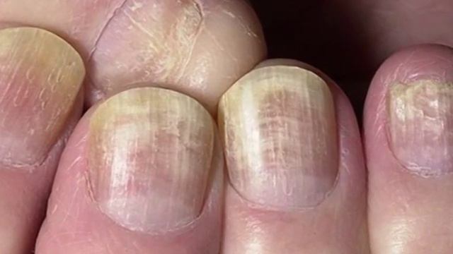 Лечение грибка ногтей. симптомы и последствия