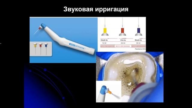 Эндодонтия 2.Ирригация системы корневого канала