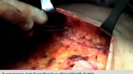 SMAS Flap Rhytidectomy