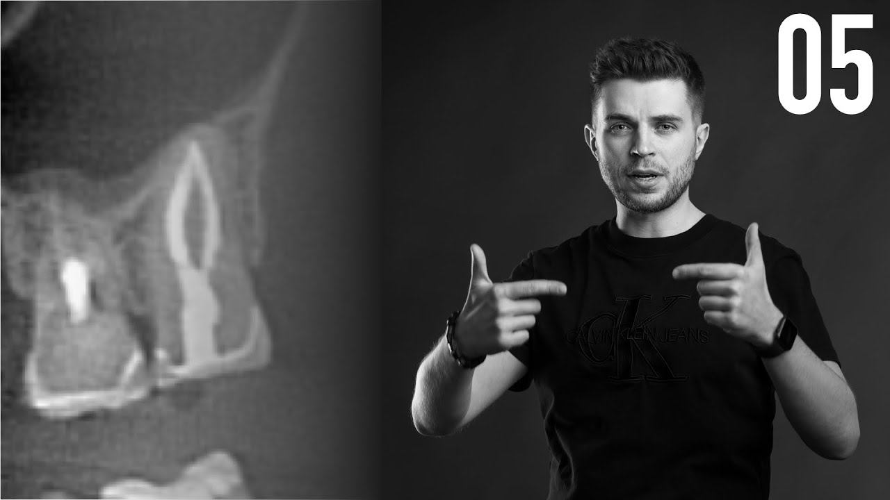 Уроки эндодонтии. Купирование болевого компонента при пульпитах